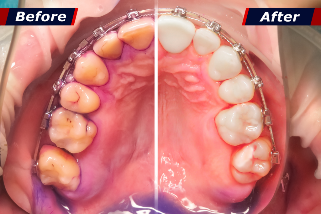 Remove Plaque And Tartar From Your Teeth At Home
