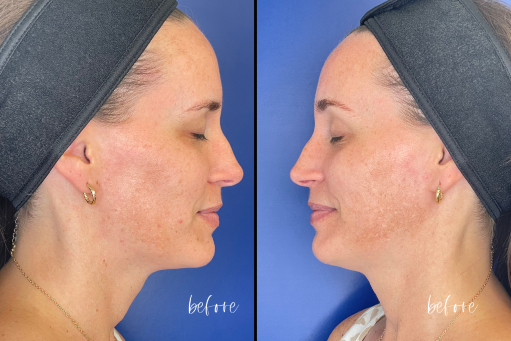 Before and After Three Treatments of SmoothGlo by Lumenis
