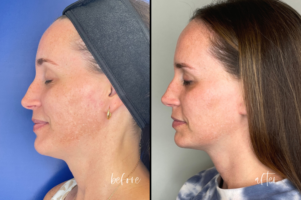 Before and After Three Treatments of SmoothGlo by Lumenis
