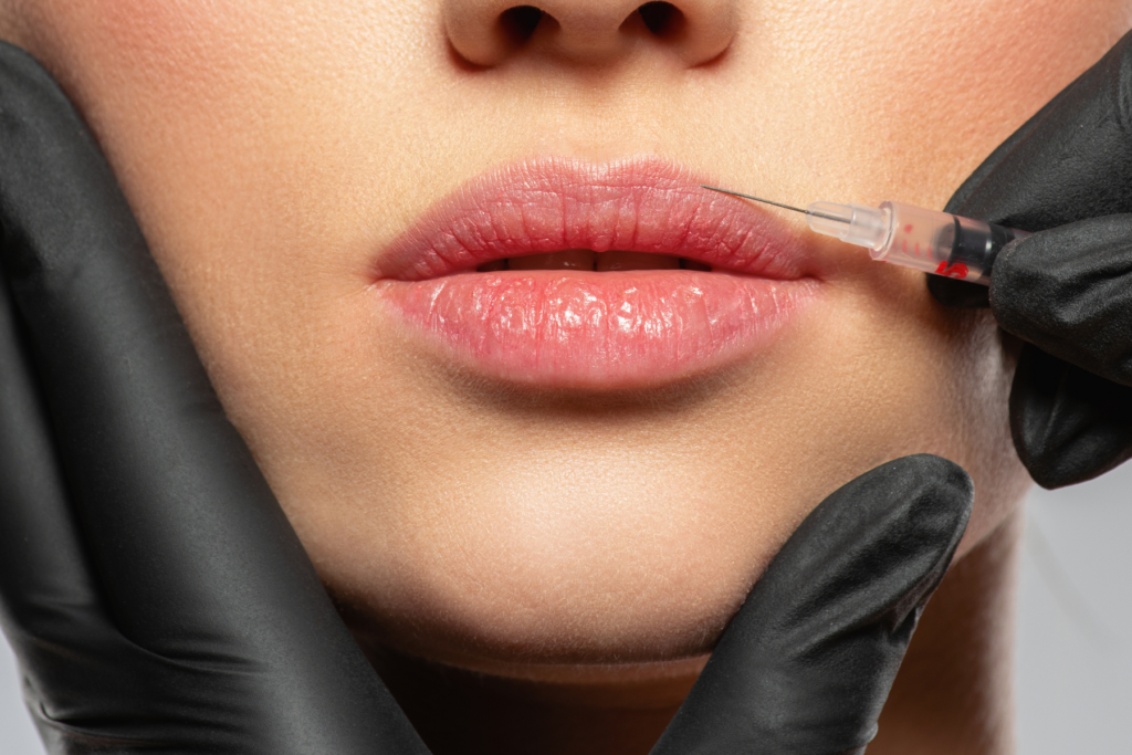 Everything you Need to Know About the Botox Lip Flip