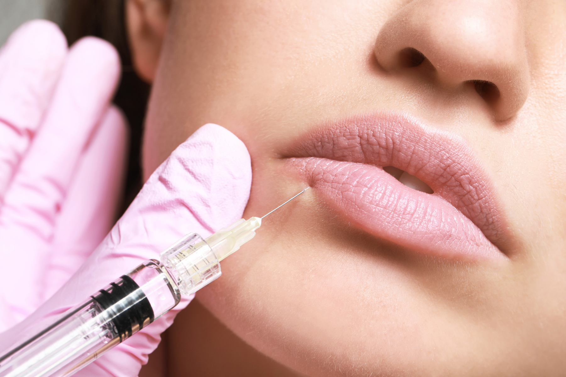 How Long Does a Botox Lip Flip Last?