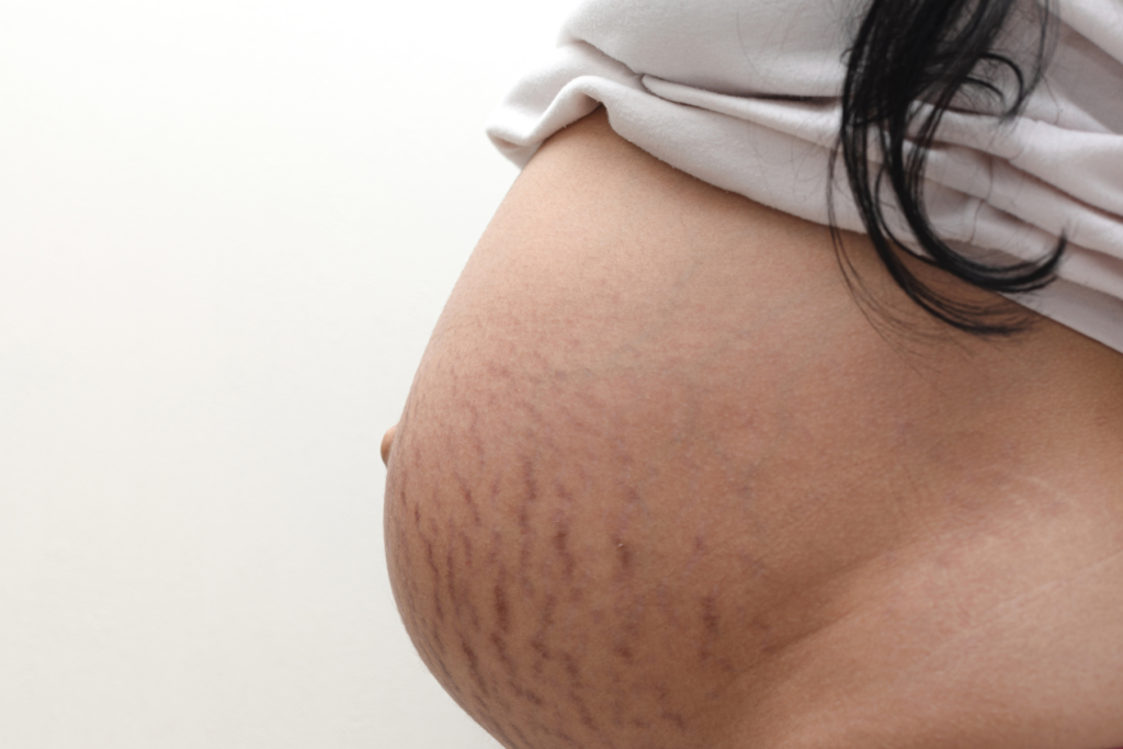 7 Best Body Lotions and Creams for Pregnancy Stretch Marks